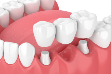Имплантация зубов в Киеве: что нужно знать о процедуре и как выбрать стоматологию