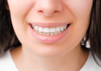Яка ціна на елайнери та їх переваги у вирівнюванні зубів